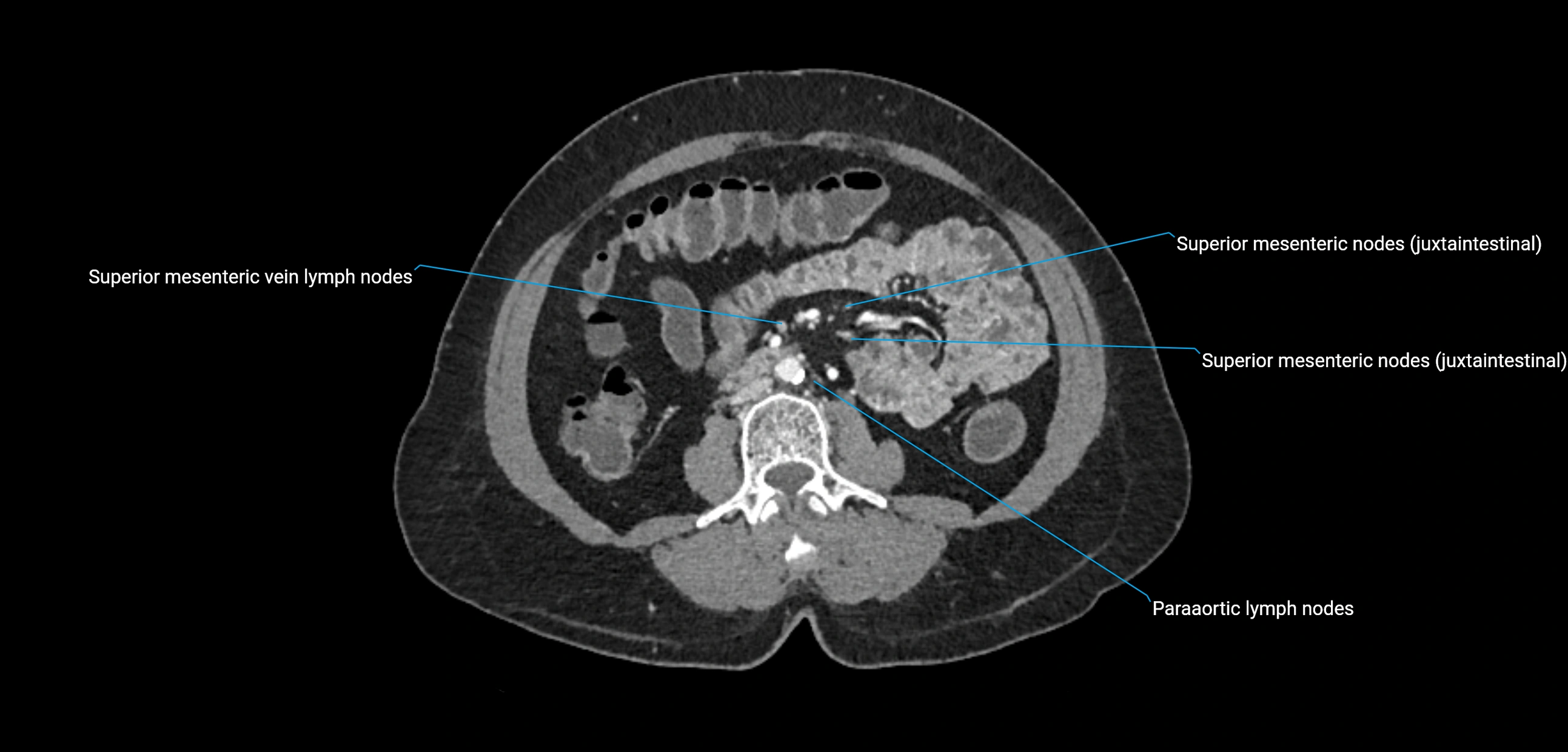 CT ct abdominal lymph nodes  axial cross sectional anatomy  enchanced radiology image -img-00002-00234.webp